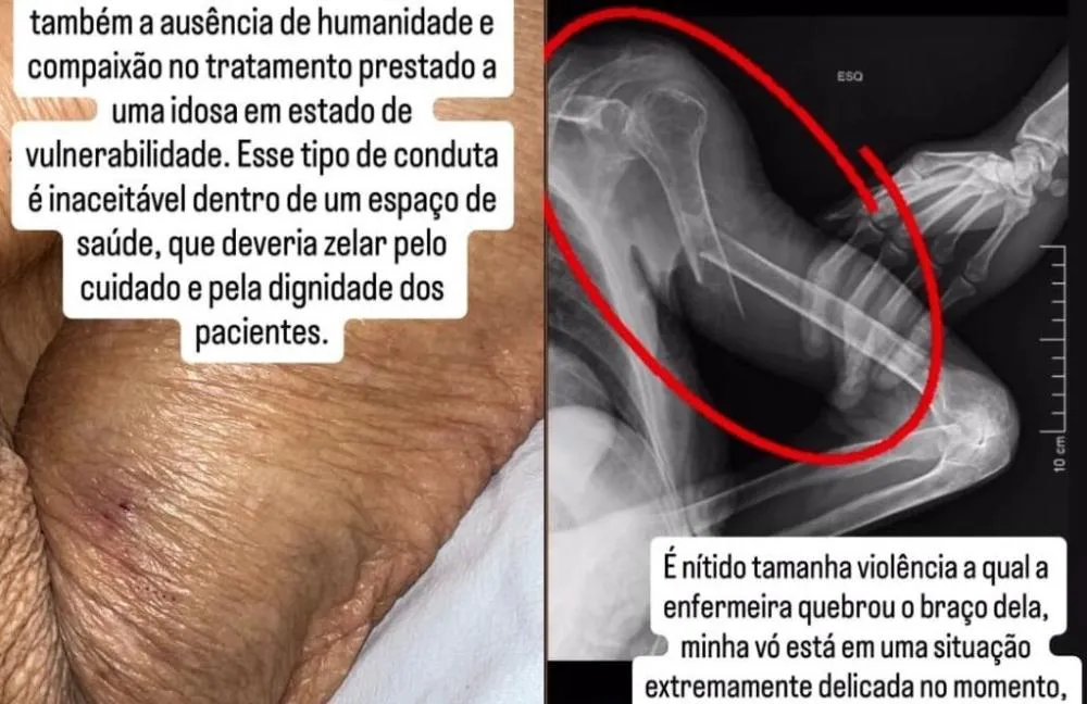 Idosa de 84 anos fratura braço durante atendimento em UPA de Caetité
